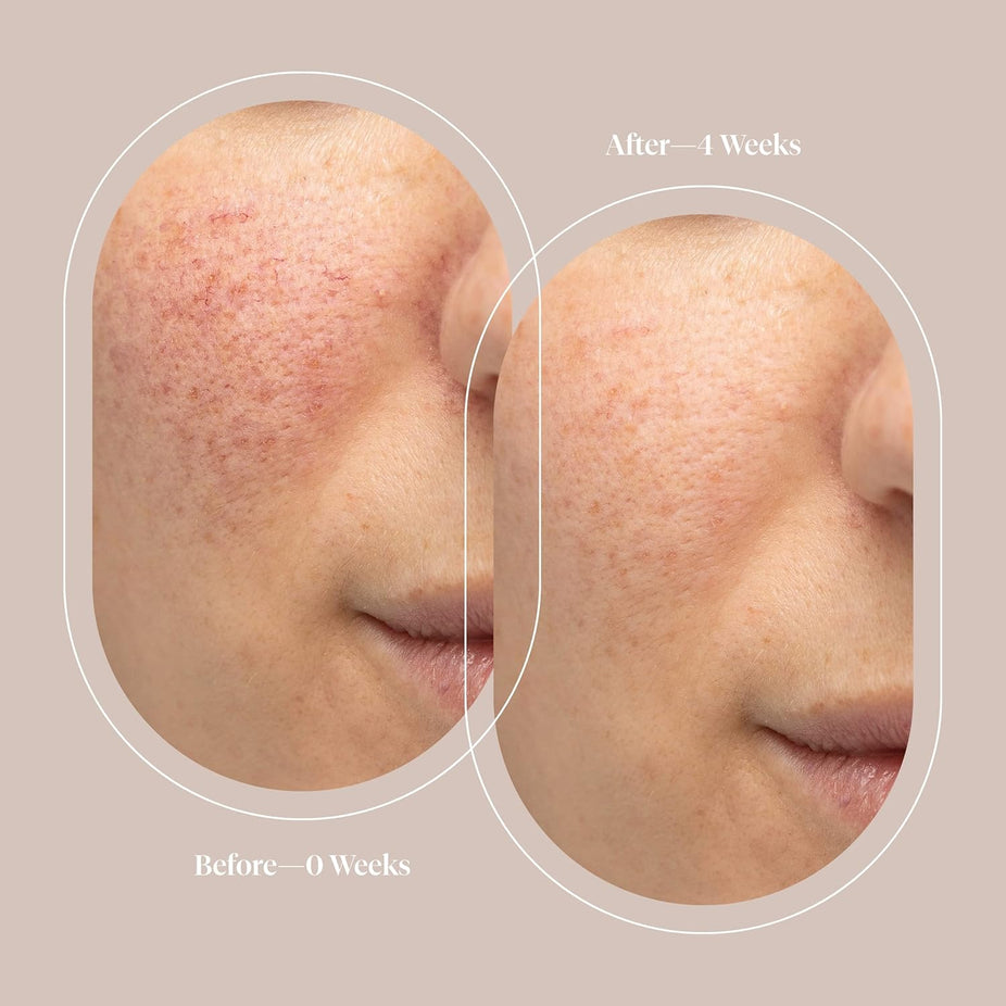 BrightenMD 4-in-1 Microcurrent Facial Toning Device